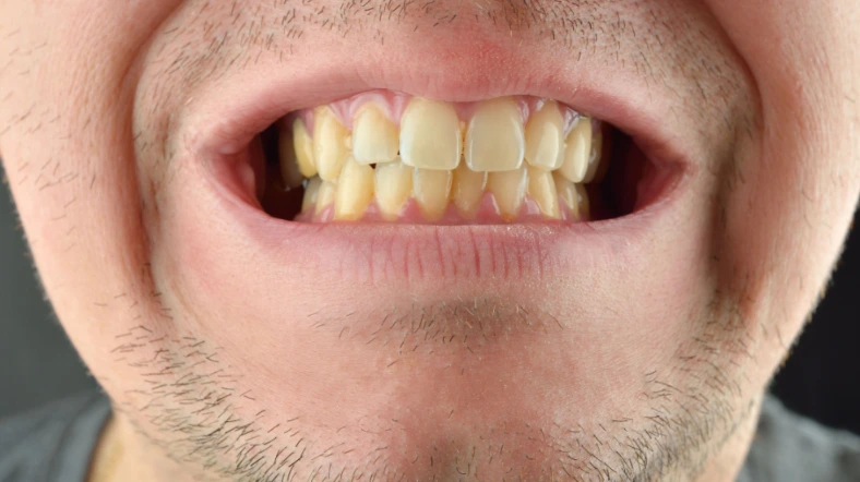 ما هي أفضل الطرق الطبية للتخلص من صفار الاسنان