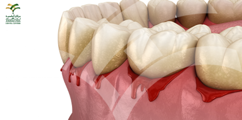 علاج انكشاف جذور الأسنان