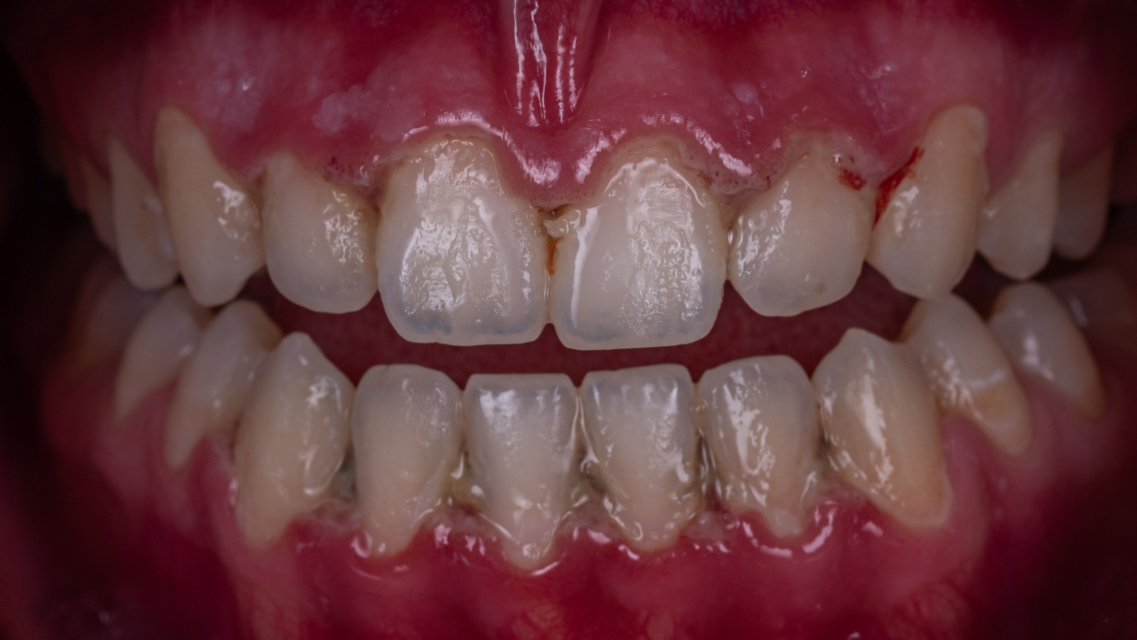 ما هو علاج جيوب الأسنان وهل يمكن علاجها بالليزر