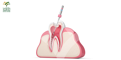 علاج جذور الأسنان