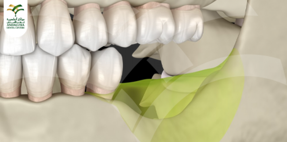 علاج تاكل عظام الاسنان