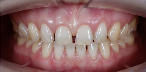 هل تنظيف الجير يؤدي إلى تفرّق الاسنان