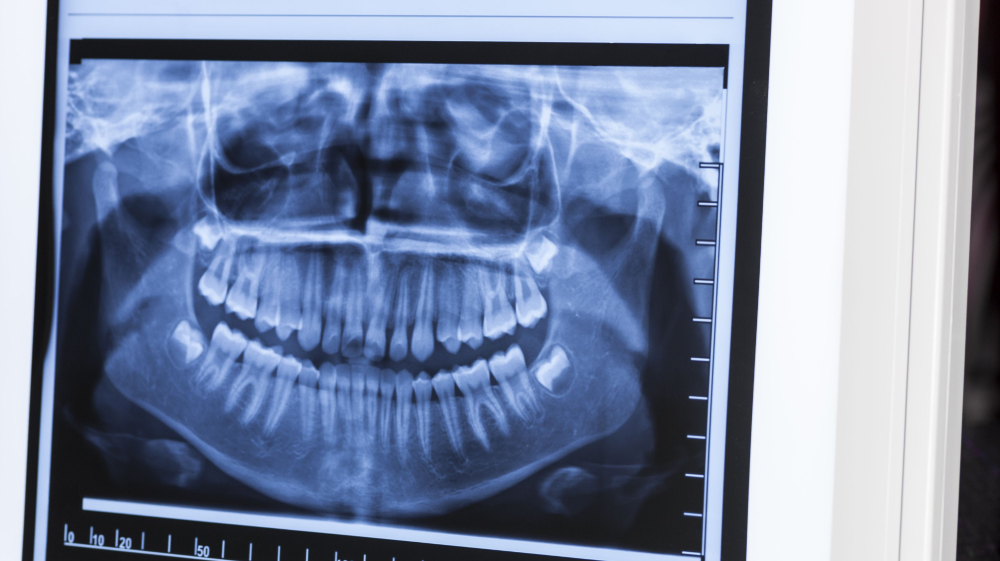 جراحة الأسنان المدفونة