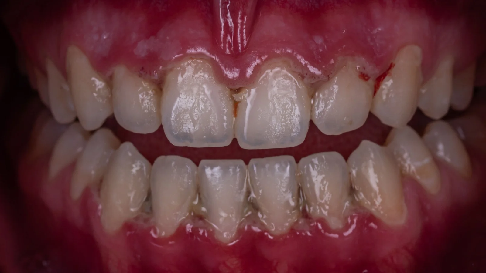 ما هو علاج جيوب الأسنان وهل يمكن علاجها بالليزر