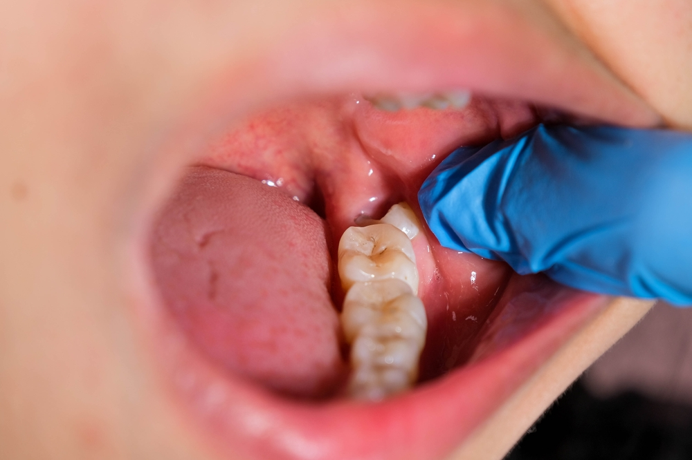 ما العلاقة بين التهاب عصب الأسنان والأذن؟