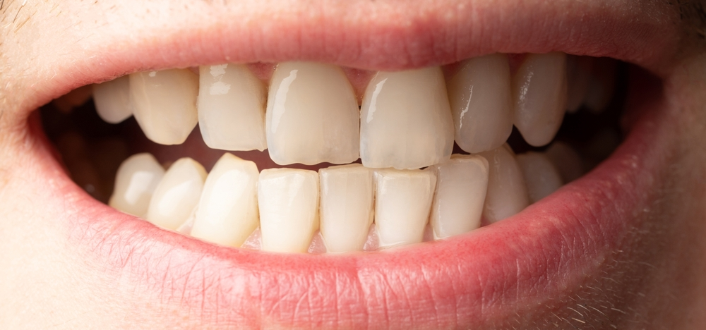 هل تنظيف الجير يؤدي إلى تفرّق الاسنان