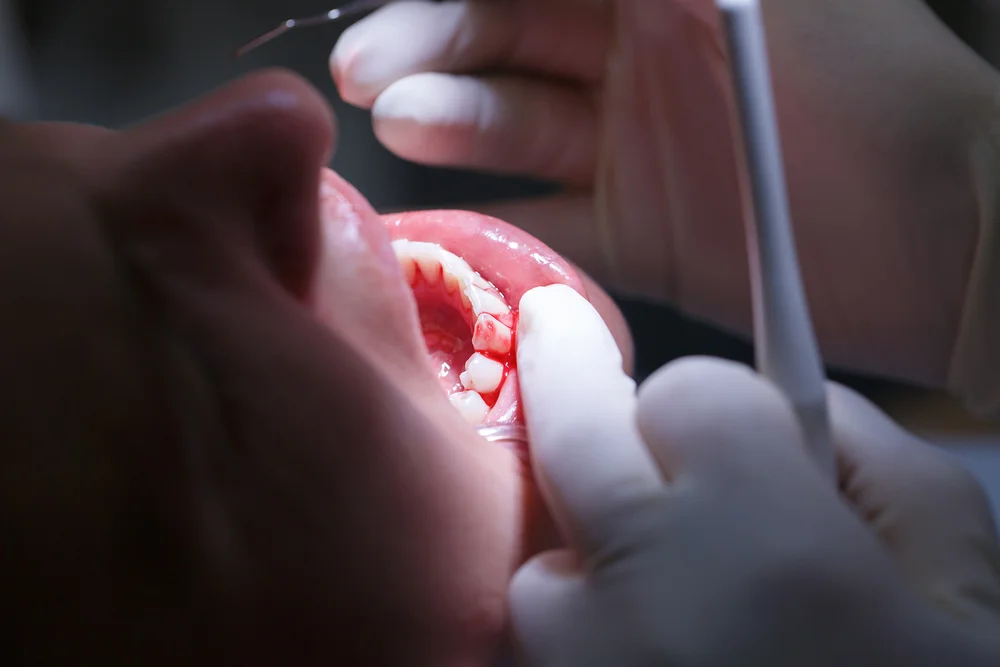 أكثر فئات معرضة لأمراض الأسنان واللثة
