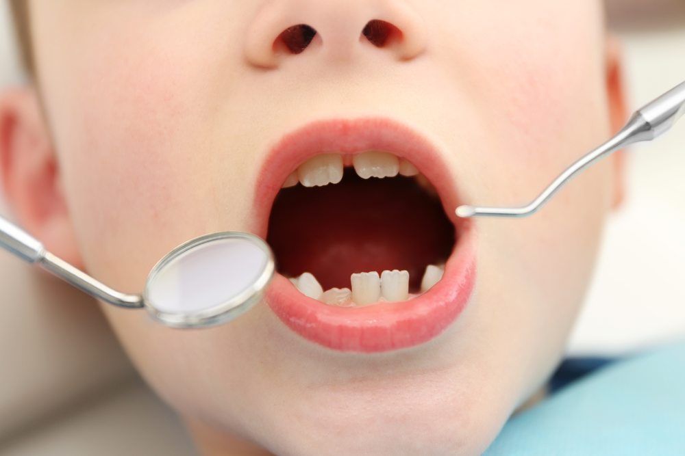 تخدير اسنان الاطفال