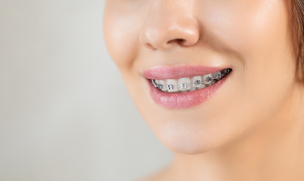 أفضل تقويم أسنان وما الطرق العلاجية في نجاح التقويم؟