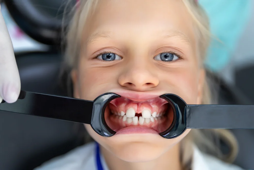 حشوات الأسنان الوقائية للصغار
