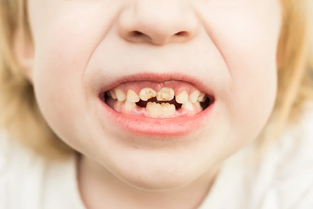 تبديل الأسنان عند الأطفال
