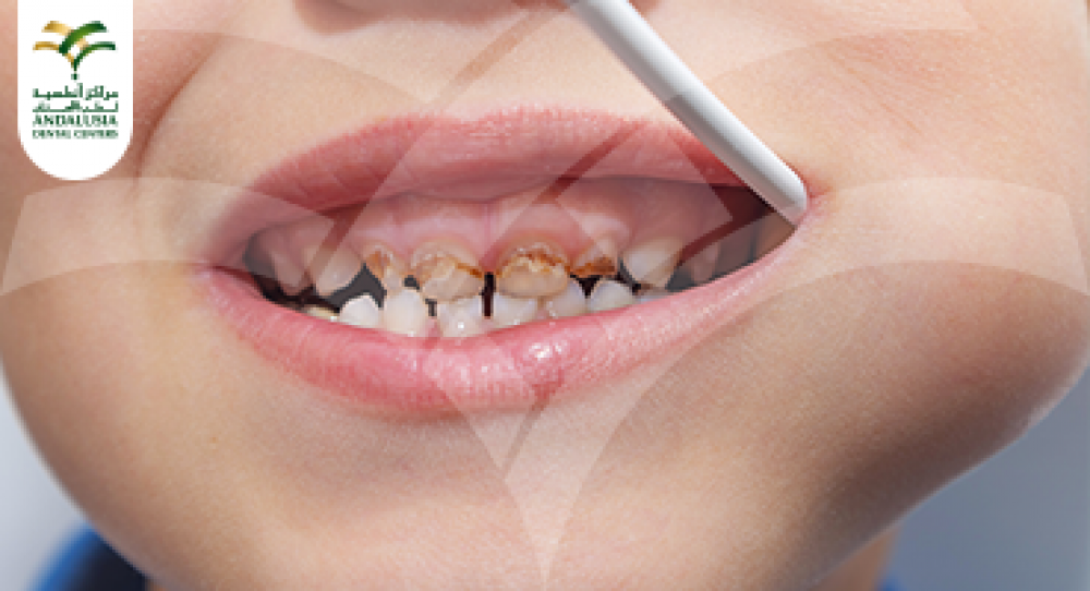 علاج تسوس الأسنان اللبنية عند الأطفال