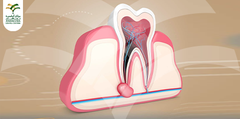علاج التهاب عصب الأسنان