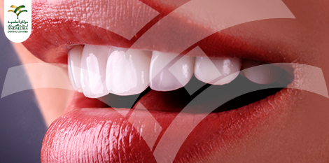 الفرق بين تلبيس الاسنان والعدسات