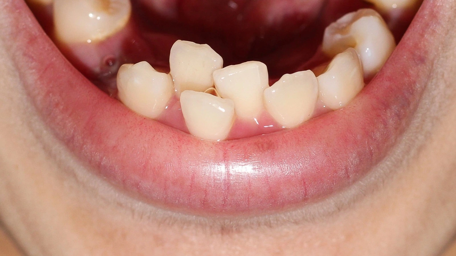 ما ِهو ازدحام الأسنان؟ وهل يمكن علاجه بدون تقويم؟