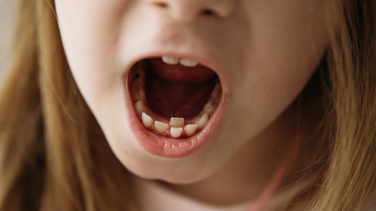 ما هي أسنان القرش عند الأطفال؟ وكيف يمكن التعامل معها؟