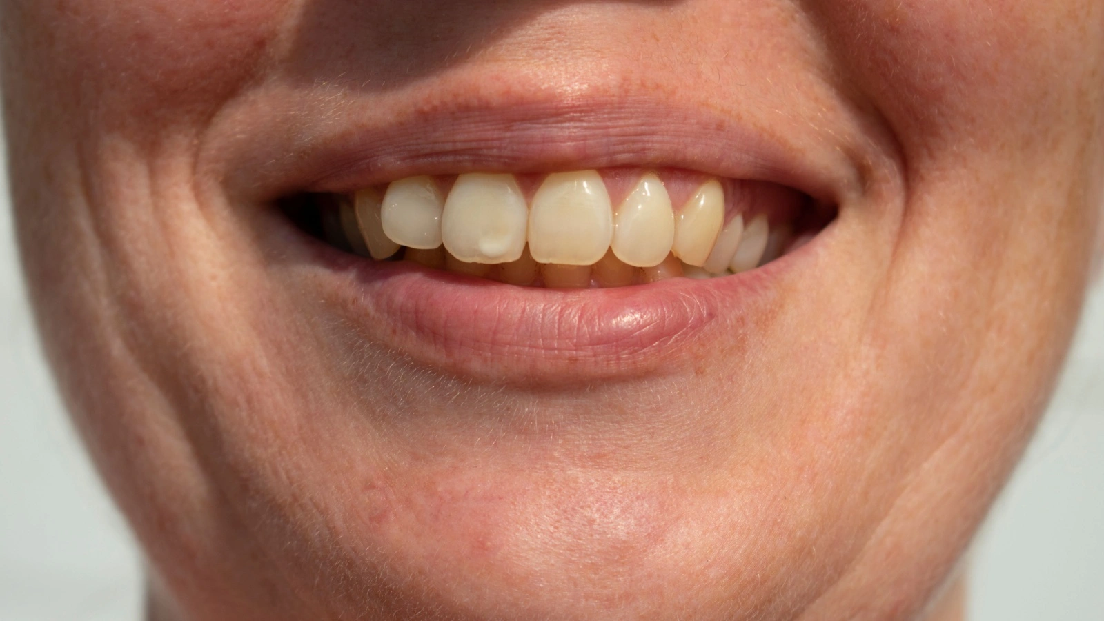 ما هي أسباب ظهور بقع بيضاء على الأسنان؟ وما علاقتها بنقص الكالسيوم؟