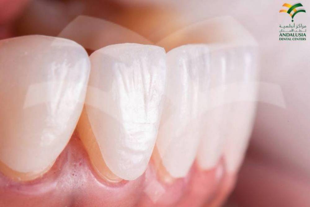 نصائح ما بعد تركيب عدسات الأسنان الفينير واللومينير