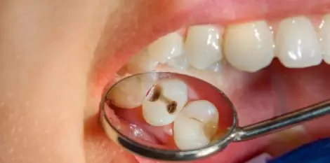 أخطر أنواع تسوس الأسنان