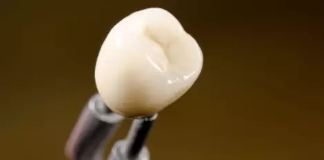 أنواع طربوش الأسنان واستخداماته