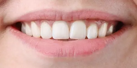ترميم الأسنان الأمامية