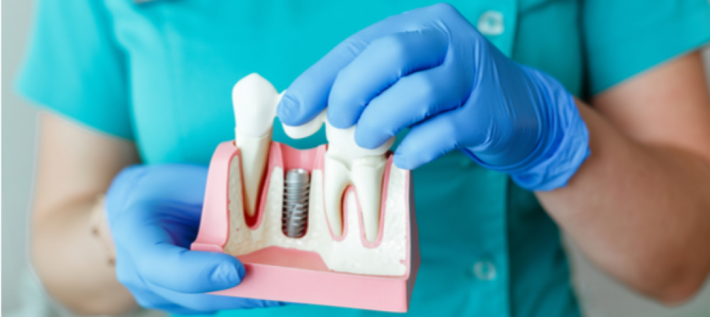 ما مميزات وعيوب زراعة الأسنان؟