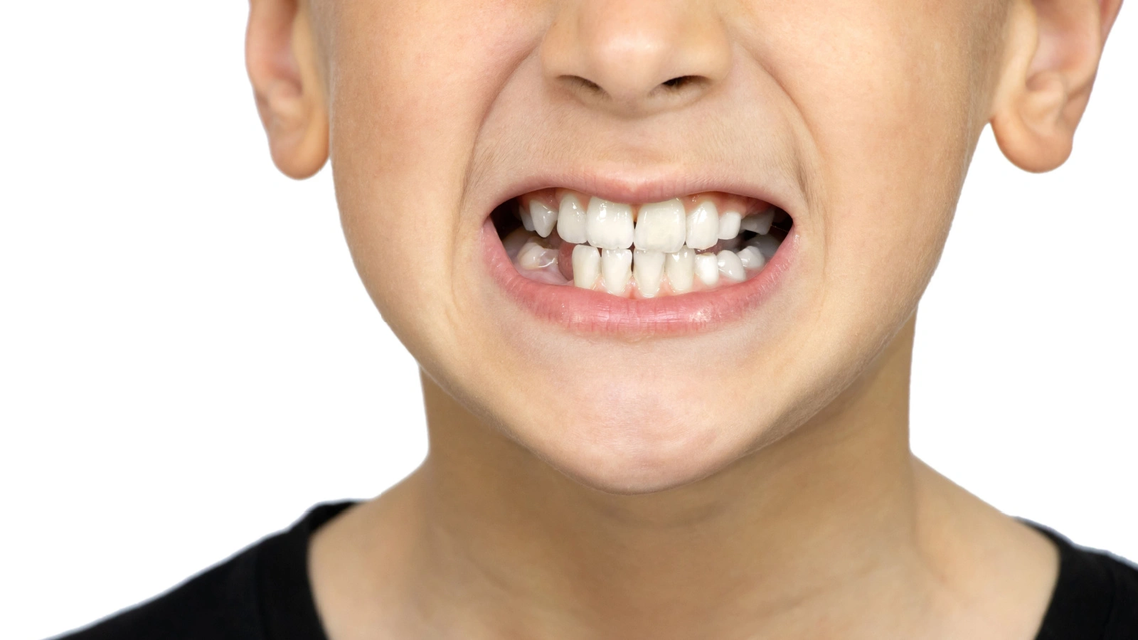 ما هي أسباب وأعراض وعلاج صرير الأسنان عند الأطفال؟