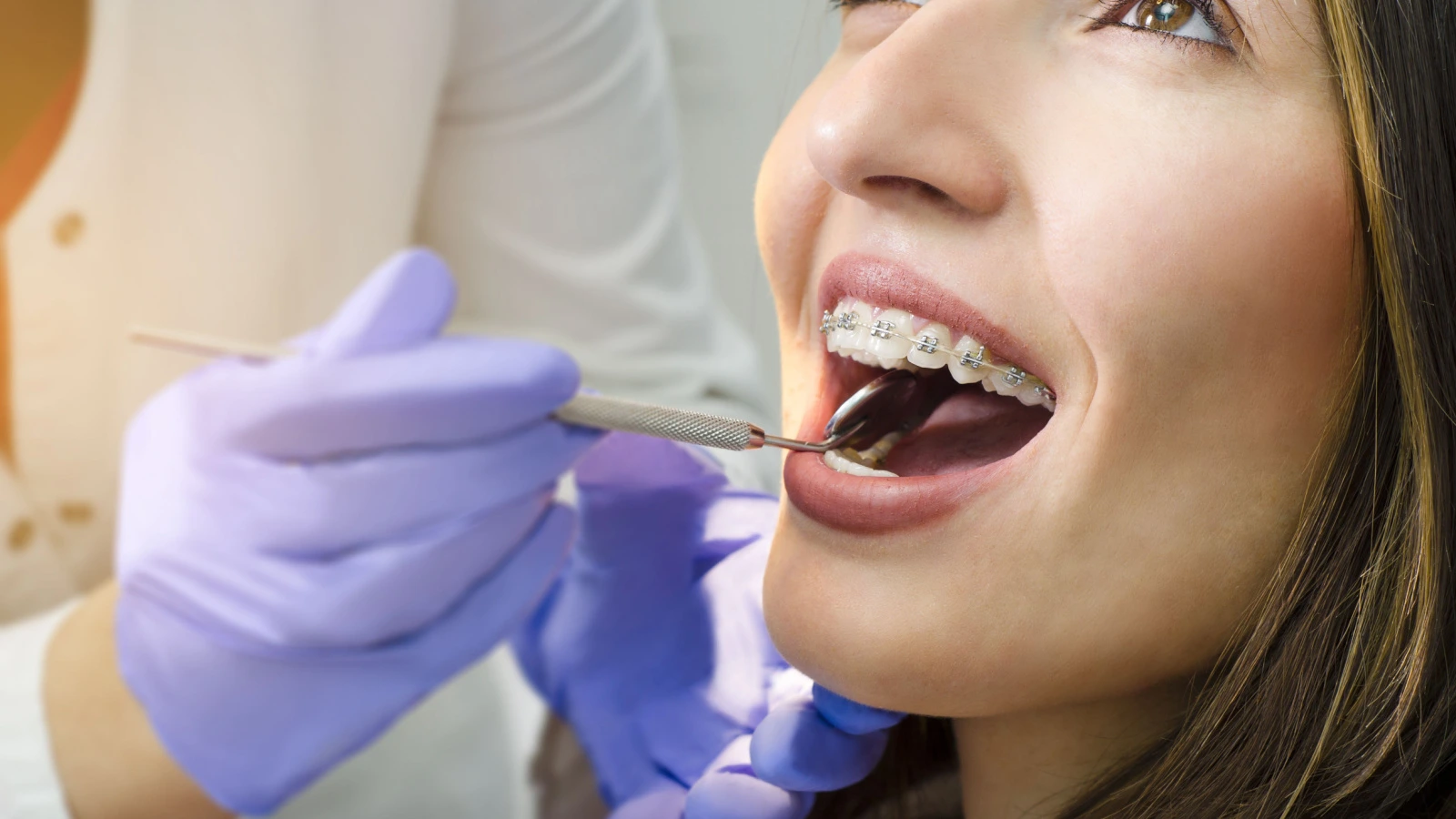 كم مدة تقويم الأسنان الأمامية؟ وما هي أنواع تقويم الأسنان المعوجة؟