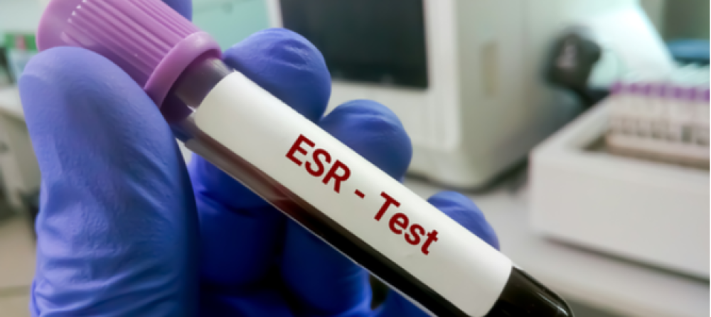ما تحليل الـ ESR؟ وما علاقته بفيروس كورونا؟