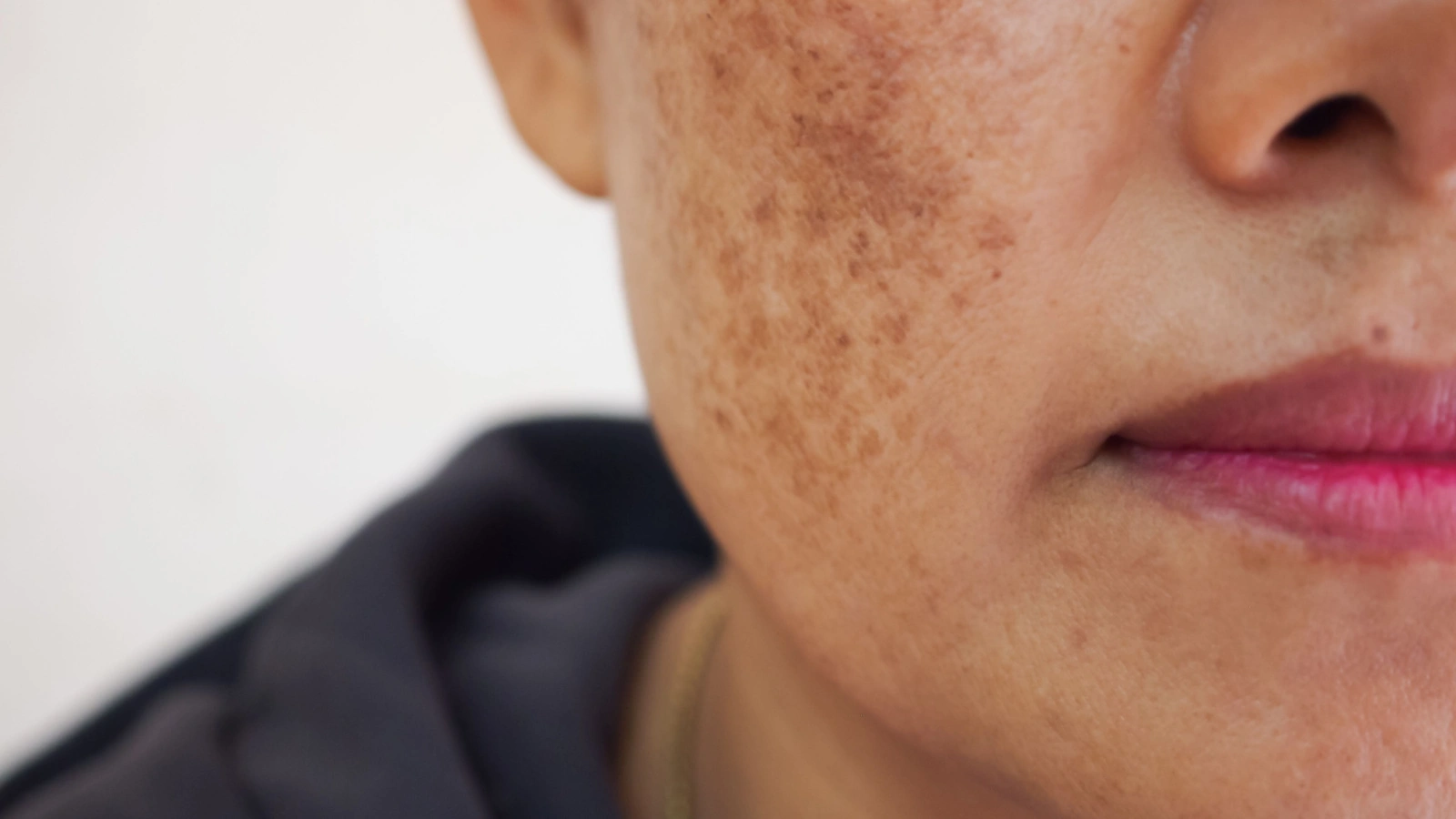 ما أسباب ظهور البقع الداكنة في الوجه؟ وما أنواعها وطرق علاجها والوقاية منها؟