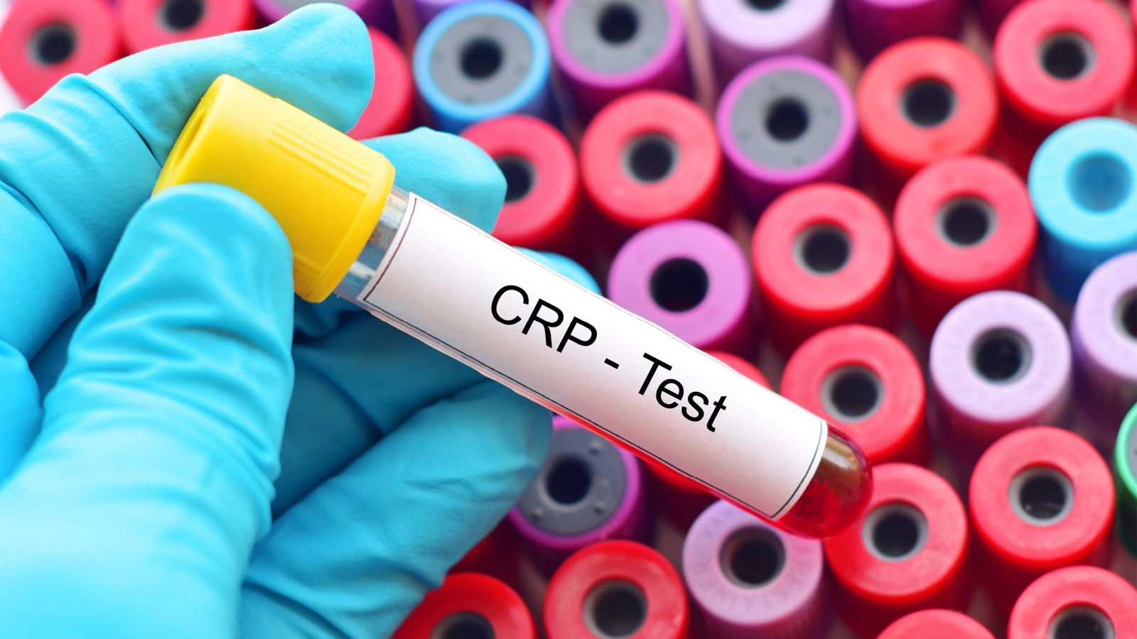 ما هو تحليل الـ CRP؟ وما علاقته بفيروس كورونا؟