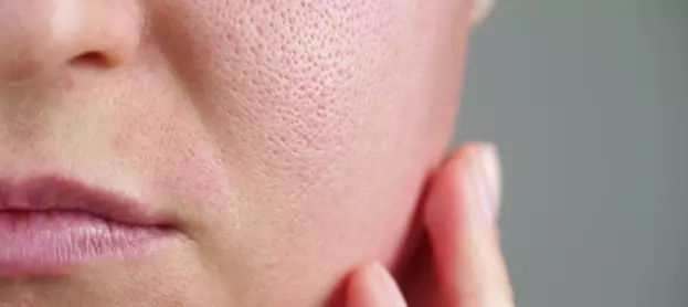 كيفية علاج المسام الواسعة المفتوحة في الوجه طبيًا