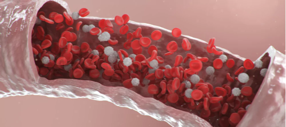 ما أعراض التهاب الأوعية الدموية؟ وكيف يمكن تشخيصها وعلاجها؟
