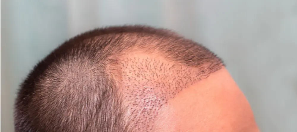 ما خطوات عملية زراعة الشعر؟