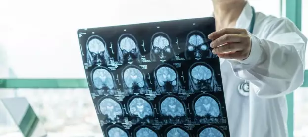 ما هي أعراض جلطات الدماغ قبل حدوثها؟ وكيفية الوقاية منها؟