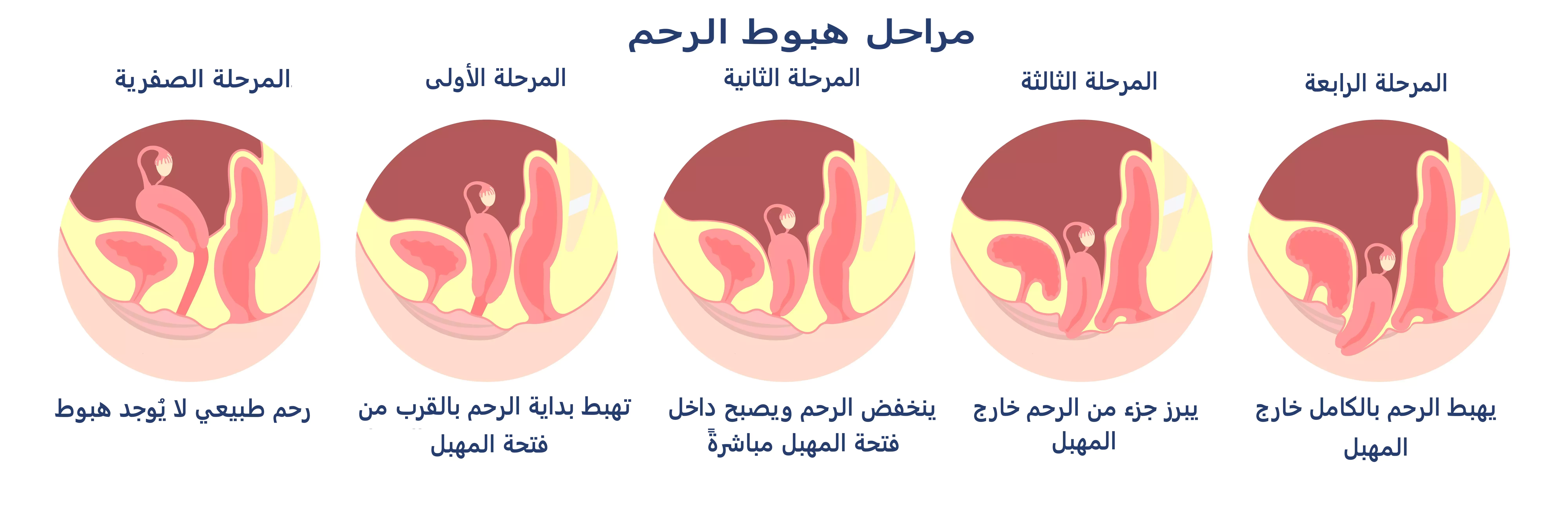 ما هي مراحل نزول الرحم؟ 