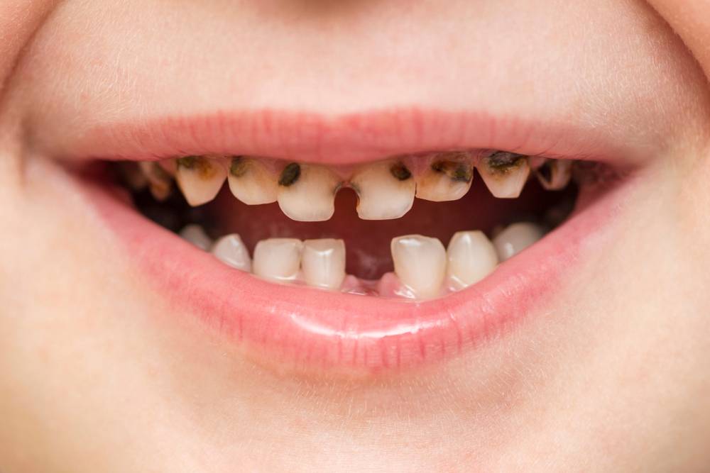 علاج تسوس الاسنان للاطفال