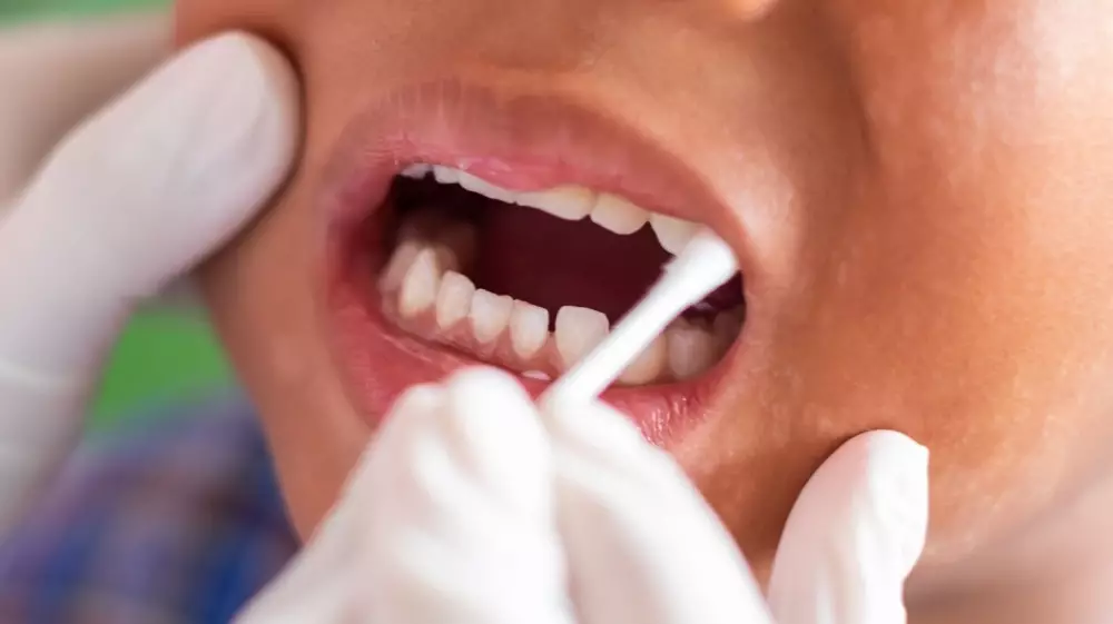 أهمية جلسات الفلورايد لوقاية أسنان الأطفال من التسوس