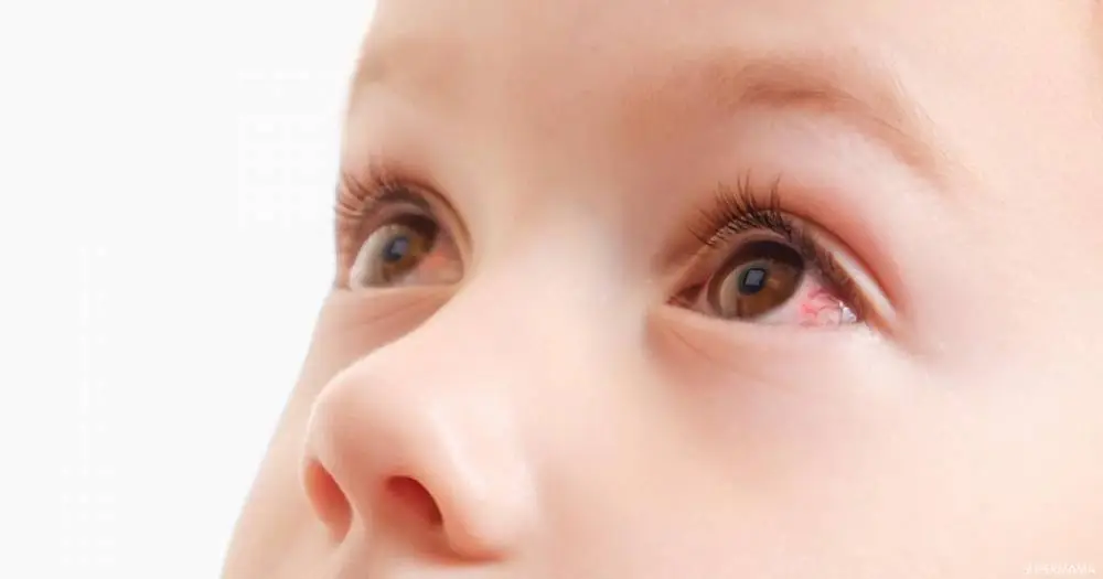 ما أسباب الم العين عند الاطفال؟ وما علاجه؟