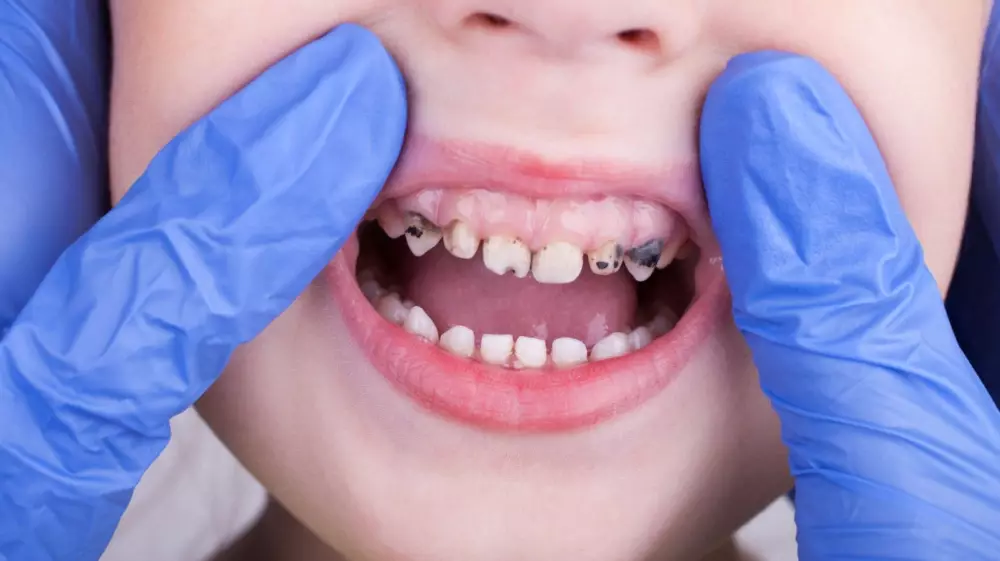 خلع الأسنان اللبنية المسوسة