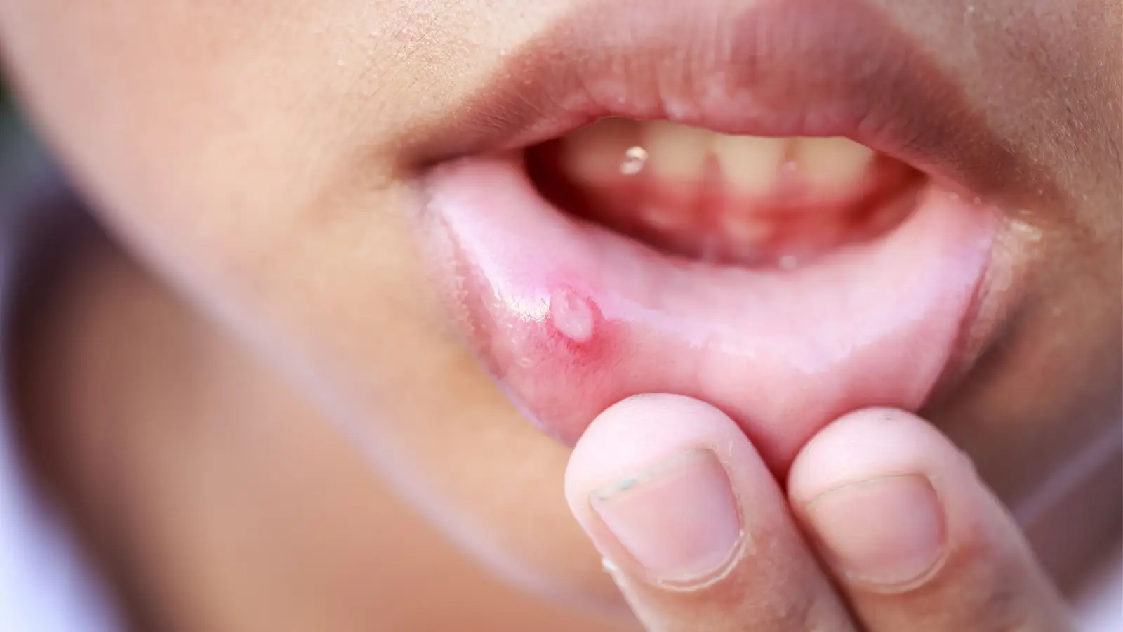 علاج هربس الفم عند الأطفال