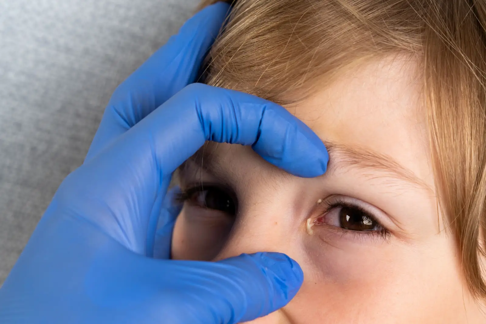ما سبب احمرار العين عند الأطفال؟