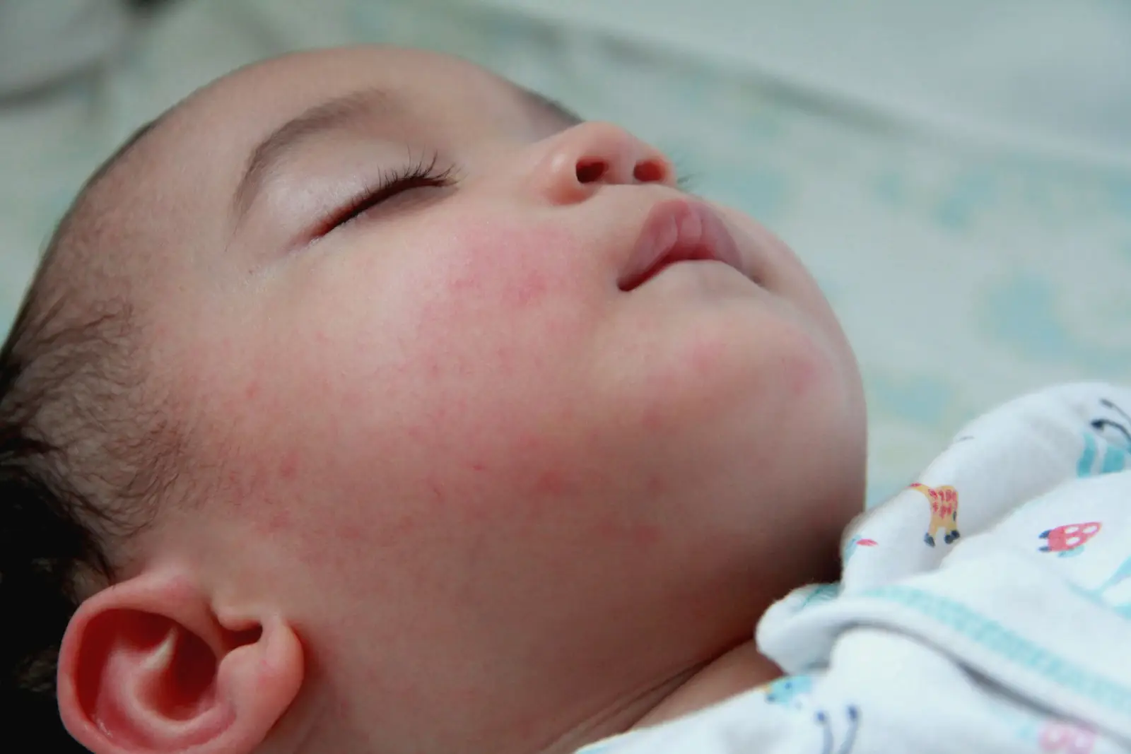 ما هو مرض كاواساكي للأطفال؟ وما علاقته بفيروس كورونا؟