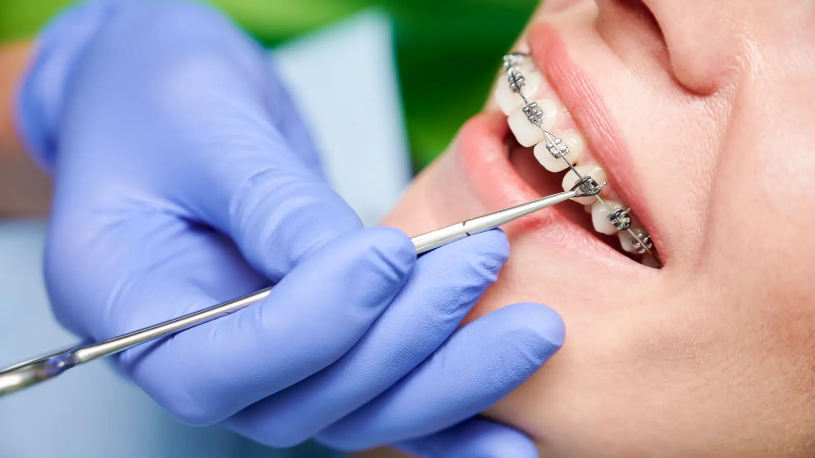 ما أنواع تقويم الأسنان عند الكبار؟ وما فوائده؟