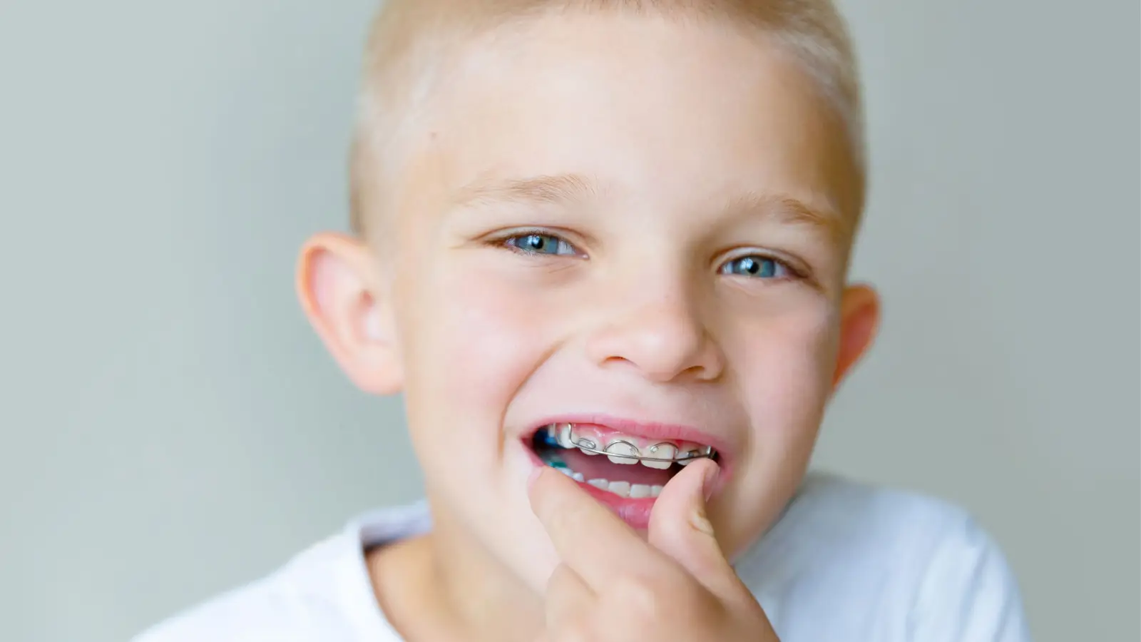 العمر المناسب لتقويم اسنان الاطفال