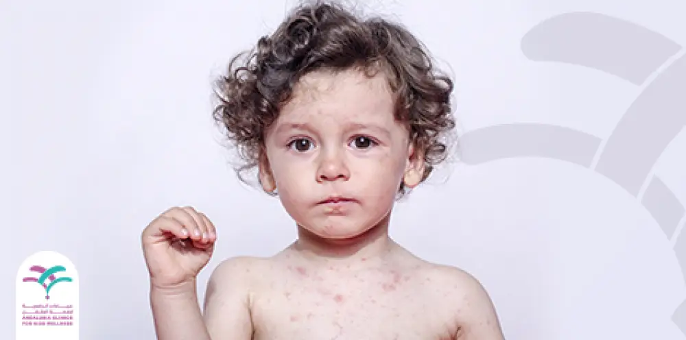 ما أعراض الإكزيما عند الأطفال؟