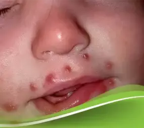 شكل مرض الهربس الجلدي