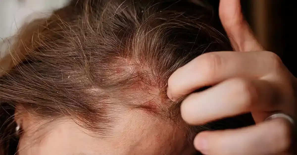أفضل علاج لصدفية الشعر عند الأطفال