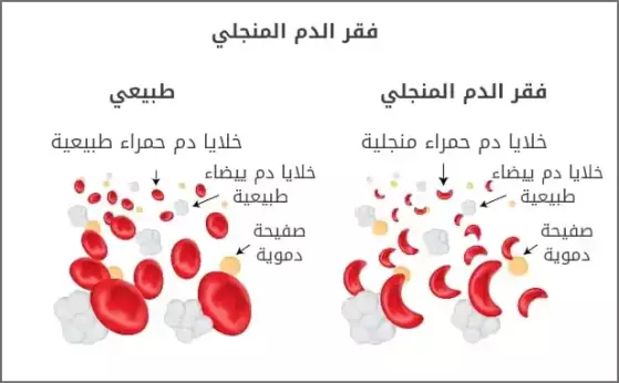 أنواع فقر الدم المنجلي