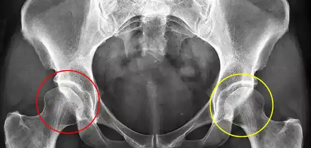 نسبة نجاح عملية خلع الورك للاطفال